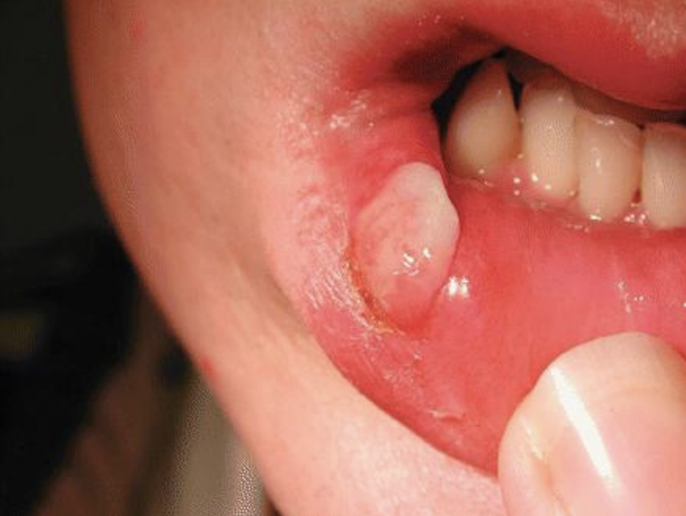 Cancro duro na boca