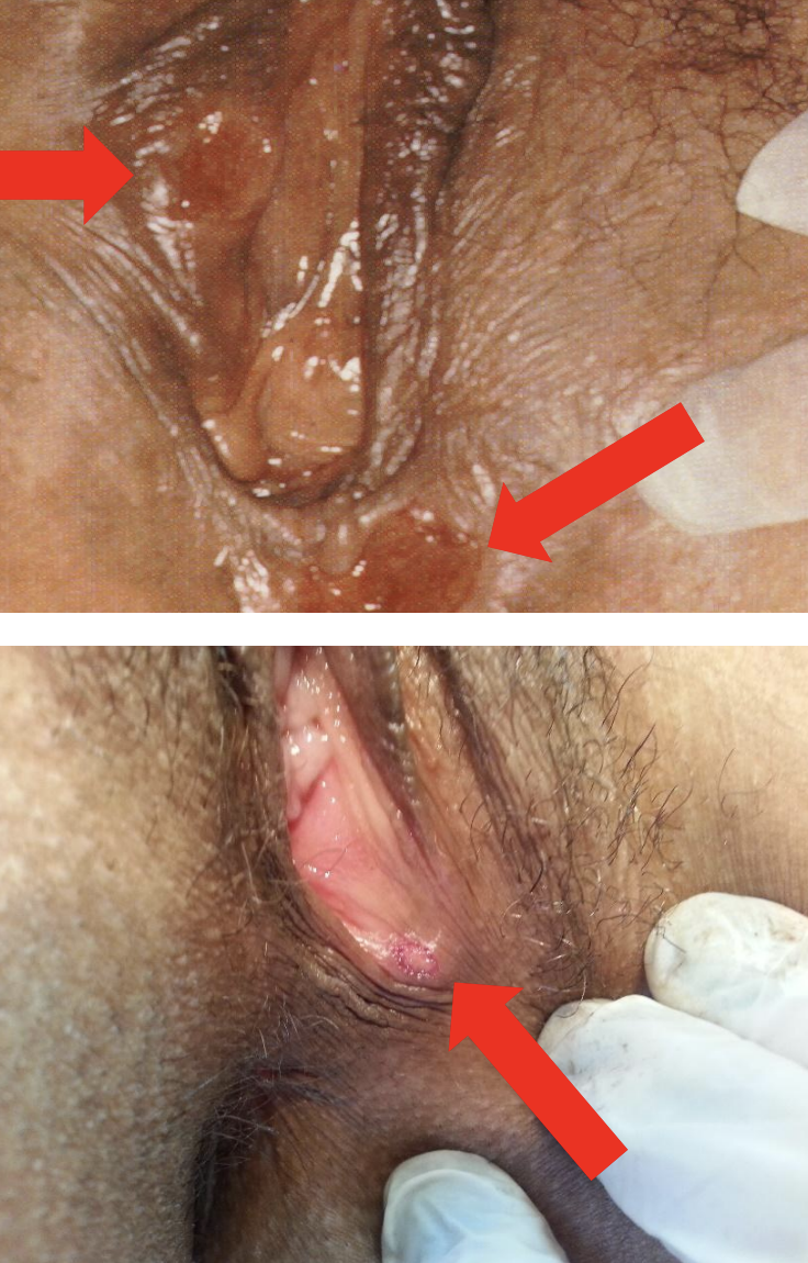Cancro duro na vulva