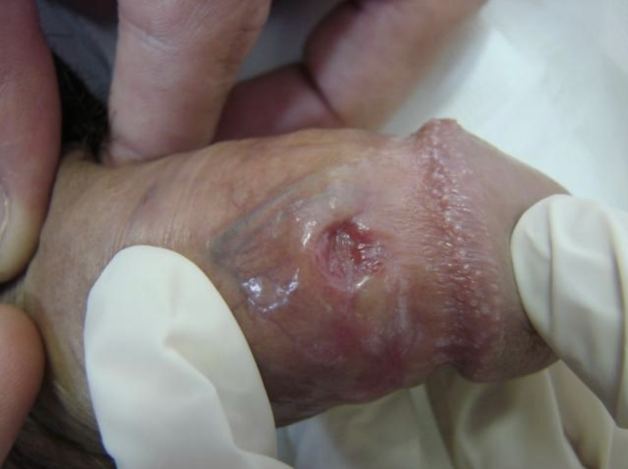 Cancro duro no pênis